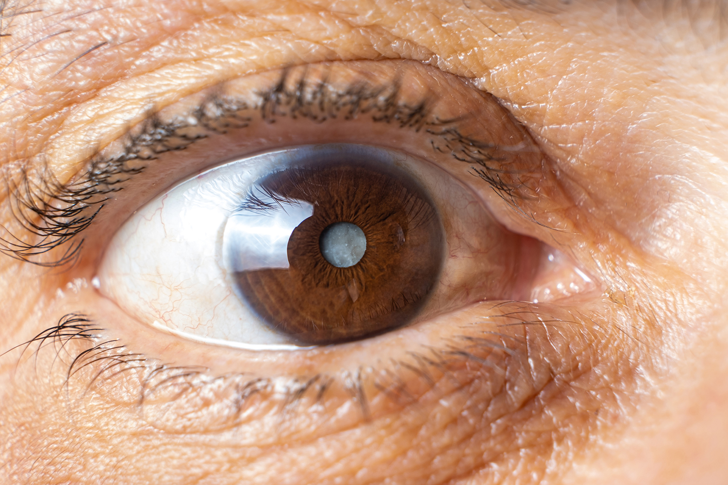 a close-up of an eye with a cloudy pupil